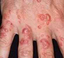 Aktinični dermatitis: vzroki, simptomi, zdravljenje