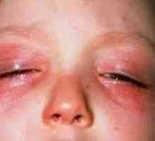 Alergija na očeh, kot kaže? Kako za zdravljenje?