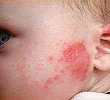 Alergija pri dojenčkih, vzroki, simptomi, zdravljenje