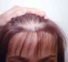 Androgene alopecije pri ženskah, simptomi, zdravljenje