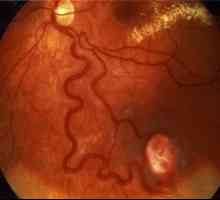 Mrežnice angiomatosis oči