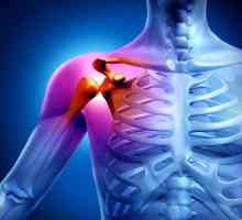 Artritis ramenskega sklepa: Simptomi in zdravljenje