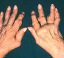 Artritis sklepov prstov: Simptomi in zdravljenje
