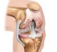 Osteoartritis stopnje kolena 3: Zdravljenje