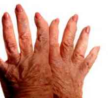 Osteoartritisa prstih, simptomih in zdravljenju