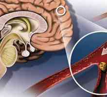 Simptomi in zdravljenje cerebralne ateroskleroze