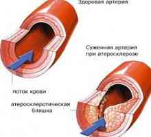Ateroskleroza