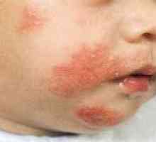 Atopijski dermatitis pri dojenčkih - Simptomi, Zdravljenje