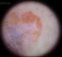 Amelanotičnega melanoma: simptomi, vzroki napovedi