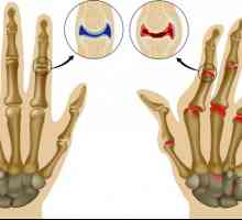 Biološko zdravljenje revmatoidnega artritisa: obdelava in droge