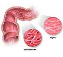 Crohnova bolezen