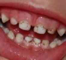 Kaj storiti, če vaš otrok zobne obloge na zobeh?