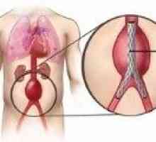 Kaj je anevrizma abdominalne aorte?
