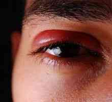 Kaj je hladno boleče oči?