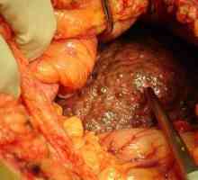 Cirozo jeter - glavni simptomi, vrste in zdravljenje tsiroz