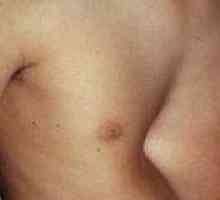 Prsih deformacija: simptomi, zdravljenje