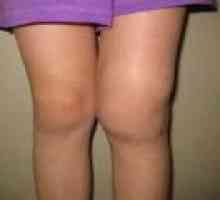 Deformiranje artroza kolenskega sklepa