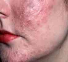 Acne Skin: Vzroki, simptomi, zdravljenje