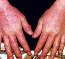 Diagnoza in zdravljenje alergijskega dermatitisa