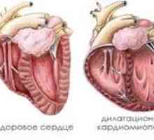 Dilatativna kardiomiopatija, vzroki, simptomi, zdravljenje