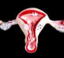 Disfunkcijske krvavitve iz maternice: vzroki, zdravljenje