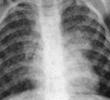 Diseminirani tuberkuloza: vzroki, simptomi, zdravljenje