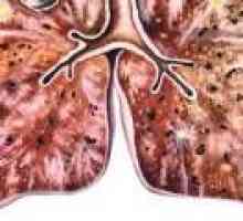 Razširjajo tuberkuloza: simptomi, zdravljenje