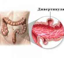 Divertikulitisom črevesa (kolona) - Simptomi in zdravljenje