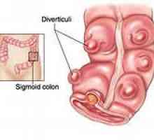 Divertikulitis - simptomi, zdravljenje, divertikulitis od sigmoidno debelega črevesa