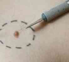Prednosti in slabosti metod zdravljenja melanoma