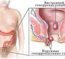 Hemoroidi po porodu: vzroki, simptomi, zdravljenje