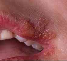 Herpes na ustnicah: vzroki, preprečevanje, zdravljenje
