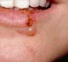 Herpes na ustnicah - vzroki, simptomi, zdravljenje