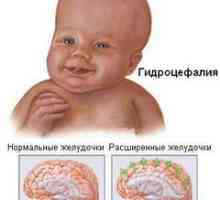 Možgani Hidrocefalija