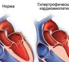 Hipertrofična kardiomiopatija, vzroki, simptomi, zdravljenje