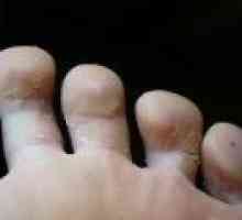 Foot gliva - popularne metode zdravljenja