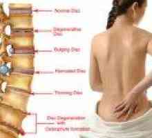 Sakralna hrbtenice kila: simptomi, zdravljenje