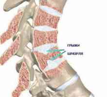 Hernija ledvene hrbtenice SHmorlja