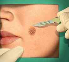 Kirurški in lasersko odstranjevanje melanoma