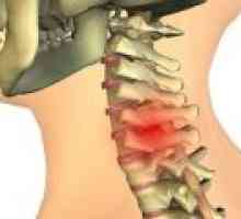 Chondrosis vratne hrbtenice: vzroki, zdravljenje
