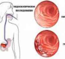 Kronični atrofični gastritis: Vzroki, simptomi, zdravljenje