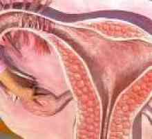 Kronična endometrija rak - vzroki, simptomi, zdravljenje