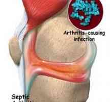 Infekcijski artritis
