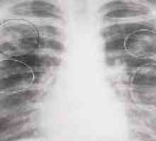 Infiltracijsko pulmonalne tuberkuloze: simptomi, faza, zdravljenje