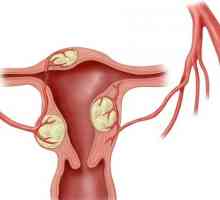 Embolizacija iz maternice fibroids
