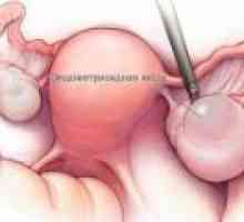 Endometrioid cist jajčnikov - vzroki, simptomi, zdravljenje