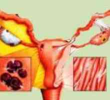 Endometrioza: simptomi, znaki, zdravljenje