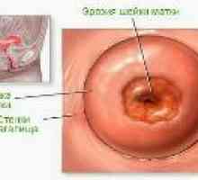 Erozija materničnega vratu v nulipare - Vzroki in zdravljenje