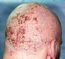 Kako ravnati z seboroični dermatitis? Zdravljenje folk pravna sredstva in medicinsko