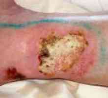 Kako za zdravljenje rane na stopalih?